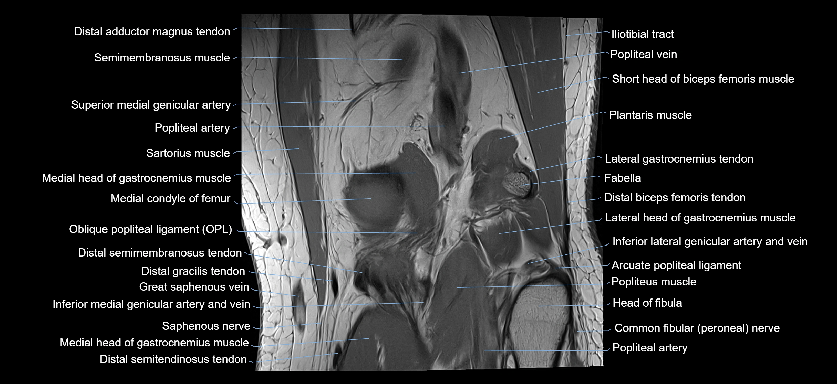 MRI knee coronal cross sectional anatomy labelled 3T radiology  image-04001-00030.webp